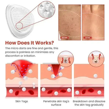 Microneedle patch treating skin tags with before and after skin images, showing painless micro darts penetration