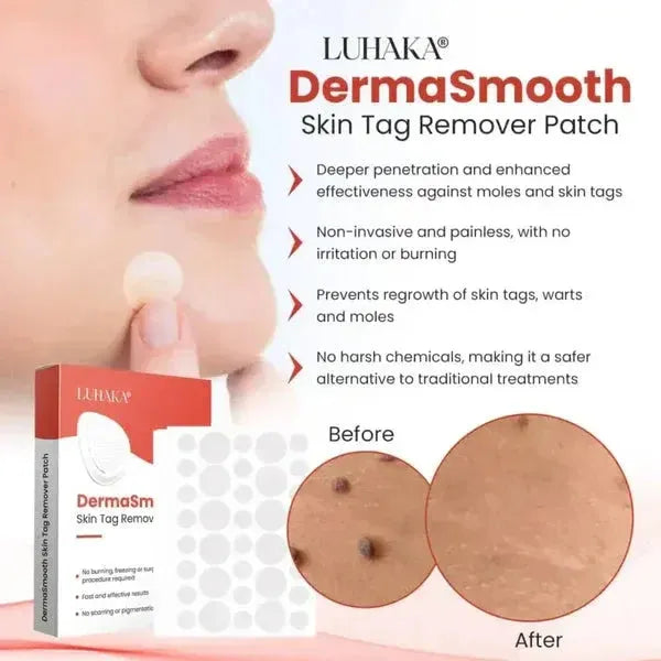 Luhaka DermaSmooth skin tag remover patch applied on chin with before and after mole removal close-up