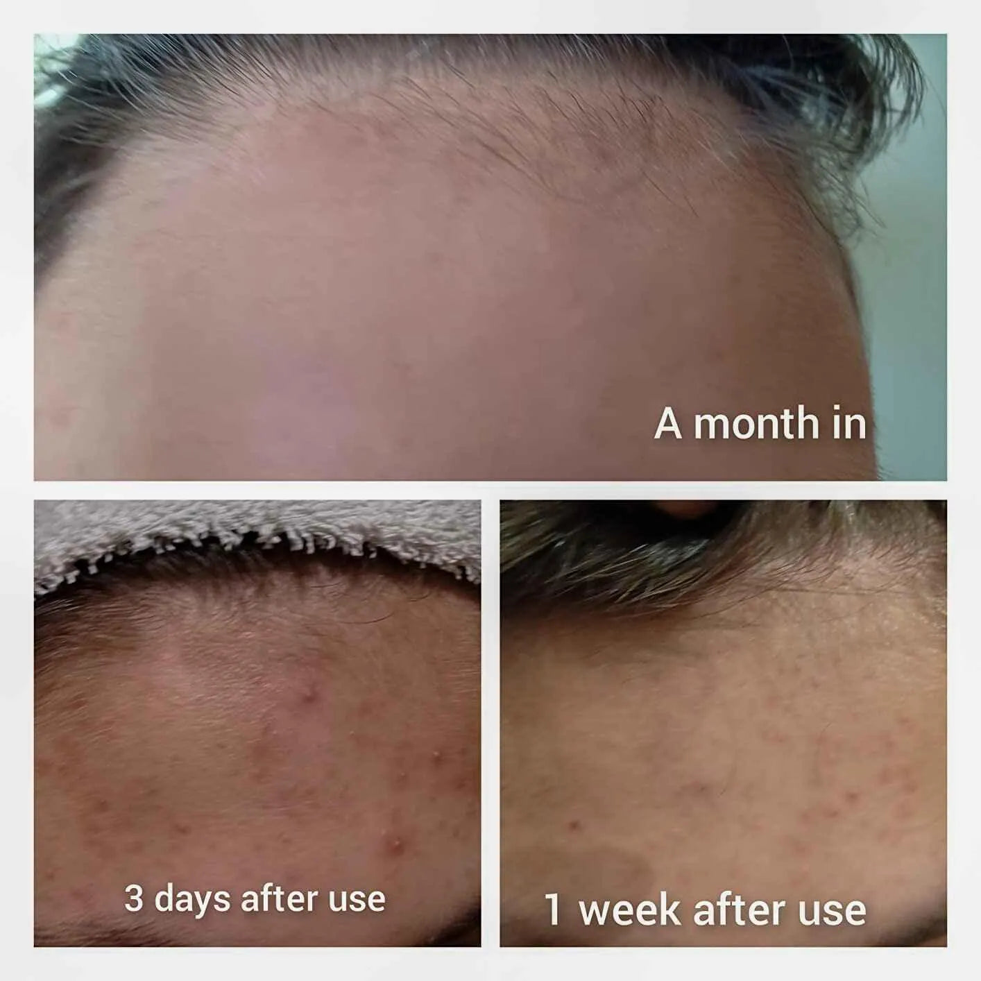 Forehead acne progression photos showing healing over 3 days, 1 week, and 1 month after skincare use